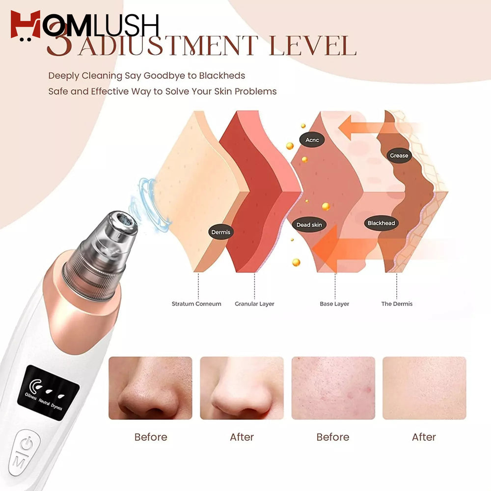 Facial acne and whitehead remover device